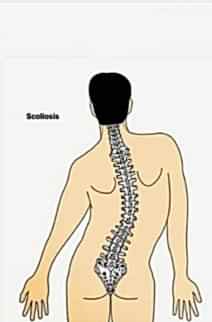 Skolyoz Nedir ?